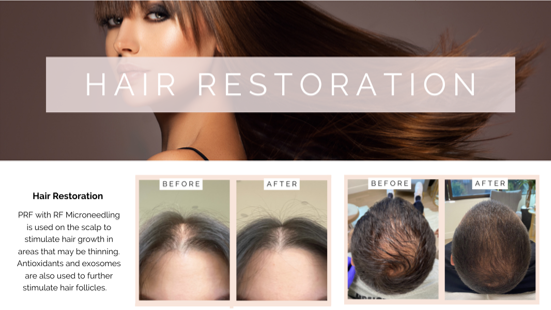 Hair Restoration - Beverly Hills/Glendale, CA | Go Flawless Now